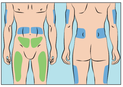 Schema del corpo umano con aree evidenziate in blu e verde che indicano possibili siti di iniezione sottocutanea o intramuscolare