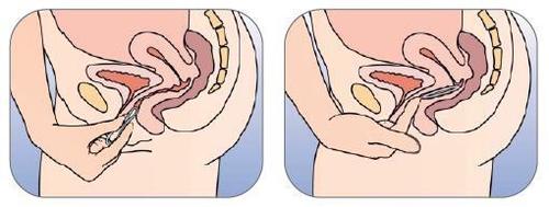 Due rappresentazioni schematizzate del tratto genitale femminile con l