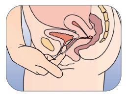 Mano che inserisce un applicatore intravaginale nell