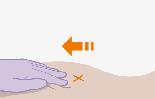 Mano con guanto viola che tiene la pelle beige, freccia arancione indica la direzione e una croce segna il punto di iniezione