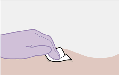 Mano con guanto viola che applica un tampone imbevuto sulla pelle beige chiara dopo un