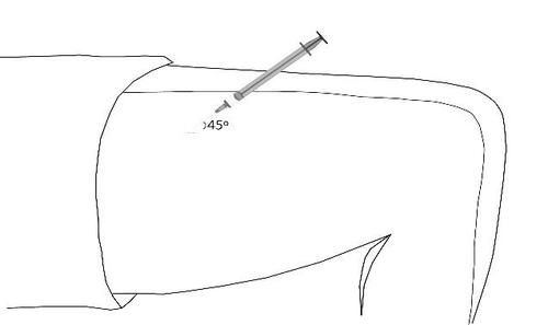 Iniezione sottocutanea con ago inclinato a 45 gradi nella pelle del braccio superiore evidenziata da linee schematiche