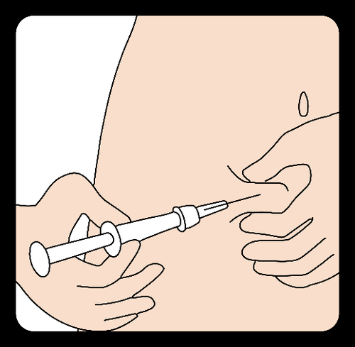 Mano che tiene una siringa con ago inserito nella pelle, tecnica di iniezione sottocutanea con angolo di circa 45 gradi