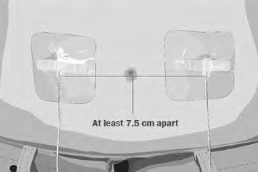 Due elettrodi adesivi rettangolari posizionati sulla schiena con una linea verticale che li connette e indica una distanza di almeno 7,5 cm
