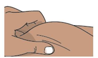 Iniezione sottocutanea nel gluteo con ago inserito e area di iniezione evidenziata in marrone chiaro