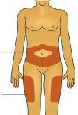 Torso umano stilizzato con aree ombreggiate che indicano i siti di iniezione nella parte superiore delle gambe e nella regione addominale