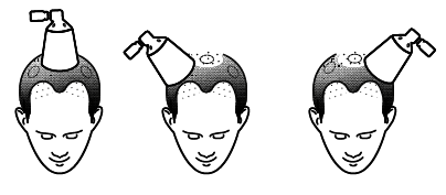 Uomo con calvizie che applica spray sulla testa in tre fasi successive per la ricrescita dei capelli