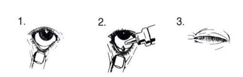 Occhio che riceve gocce da un flacone contagocce, sequenza di applicazione con passaggi numerati da 1 a 3