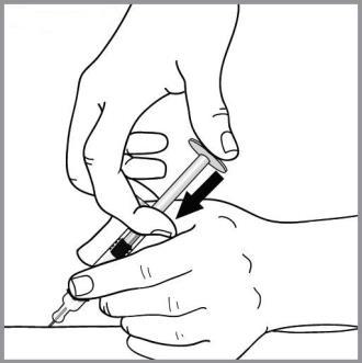 Mano che tiene una siringa preriempita con ago inserito nella pelle, freccia nera indica la direzione di iniezione