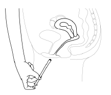 Vescica e uretra femminile con catetere inserito attraverso l