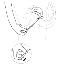 Disegno schematizzato di utero e vagina con inserimento di dispositivo intrauterino e dettaglio ingrandito dell