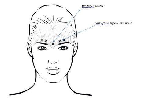 Schizzo di testa femminile con indicazioni dei muscoli corrugator supercilii e procerus tramite frecce e croci