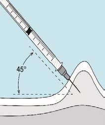 Siringa con ago che inietta un farmaco nel tessuto sottocutaneo con un angolo di 45 gradi indicato da una freccia