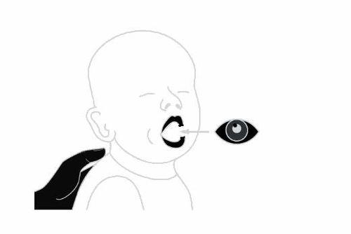 Bambino che piange a bocca aperta con una goccia oculare che viene instillata nell