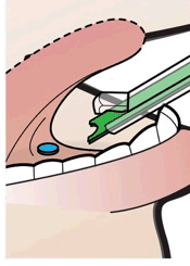 Dente con una capsula verde inserita e una piccola sfera blu posizionata vicino alla radice