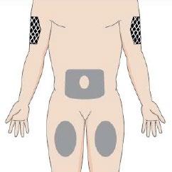 Torso umano con evidenziate aree di iniezione sottocutanea nelle cosce e nell