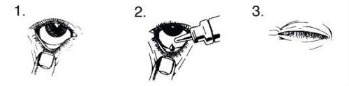 Occhio che riceve gocce da un flacone contagocce in tre fasi successive di applicazione