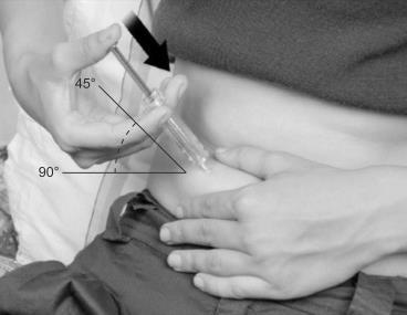 Iniezione sottocutanea con siringa a 45&deg; e 90&deg;, freccia nera indica l