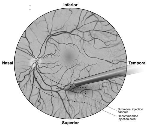 Vista retinica con indicazioni di iniezione sottoretinica tramite cannula, area raccomandata delimitata da tratteggio e punti cardinali