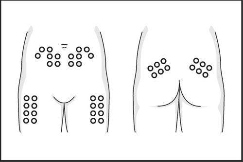 Schema di iniezione sottocutanea con aree di iniezione indicate da cerchi e frecce che indicano il punto di inserimento