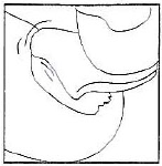 Iniezione sottocutanea con ago corto angolato a 45 gradi nella regione addominale con plica cutanea sollevata