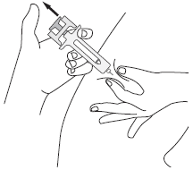 Mano che tiene una siringa prerafillata inclinata per iniezione sottocutanea nella pelle del braccio con pizzicatura
