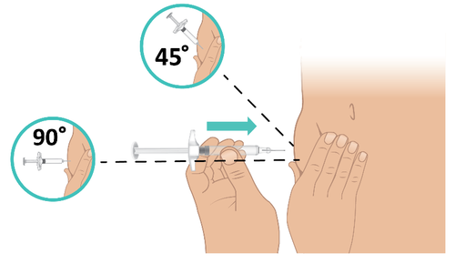 Iniezione sottocutanea con siringa a 45 e 90 gradi mostrata su braccio e mano con frecce direzionali