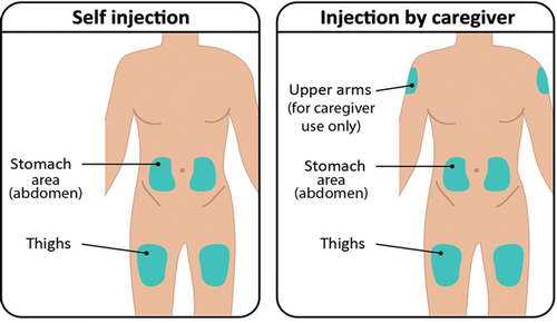 Due figure stilizzate di spalle con aree evidenziate per iniezioni addominali, cosce e braccia superiori per l