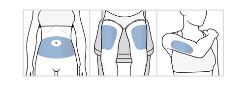 Tre schemi del corpo umano con aree evidenziate in blu addominale, fianchi e braccio superiore