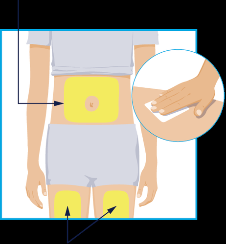 Torso umano con aree evidenziate in giallo per iniezione sottocutanea e dettaglio di mano che applica cerotto adesivo