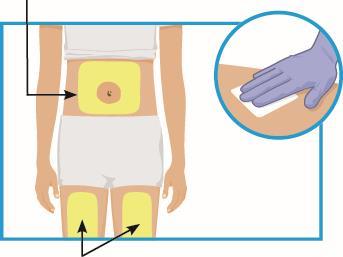 Torso femminile con indicazioni di zone di applicazione di cerotti medicinali su addome, fianchi e cosce, dettaglio di mano guantata che applica cerotto