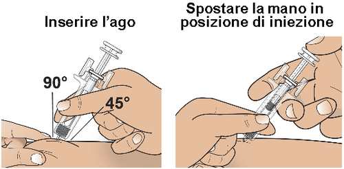 Mano che tiene una siringa inclinata a 45&deg; e 90&deg; mentre inserisce l