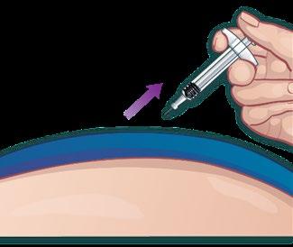 Mano che tiene una siringa con ago che inietta liquido sotto la pelle bluastra di un braccio o addome con freccia viola indicante la direzione